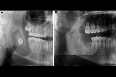 5-Fluorouracil & Odontogenic Keratocysts | Dugoni School Research