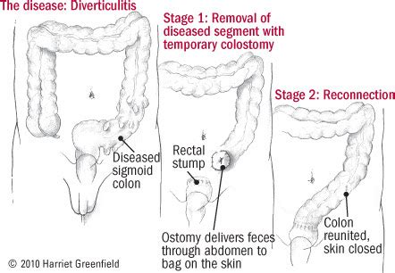 Difference Between Diverticulitis And Colon Cancer - CancerWalls