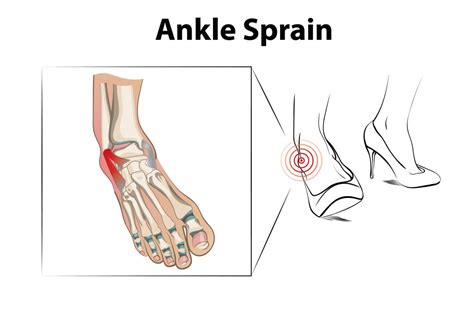 If Your Sprained Ankle Is Still Sore Months Later, Read This Now ...