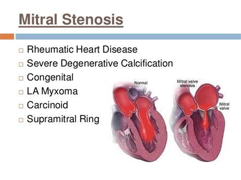 Mitral Valve Stenosis Treatment