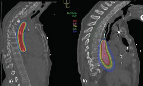 Radiation Therapy for Esophageal Cancer | IntechOpen