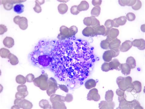 Histoplasma capsulatum in macrophage in bone marrow - 1.