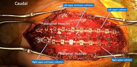 Feasibility and Analgesic Efficacy of Thoracolumbar Dorsal Ramus Nerve Block Using Multiorifice ...