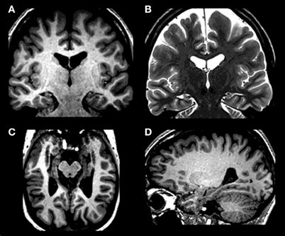 Bilateral hippocampal atrophy in ML with T1-weighted images [(A)... | Download Scientific Diagram