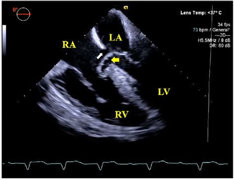 Two-dimensional transesophageal echocardiography, midesophageal image,... | Download Scientific ...