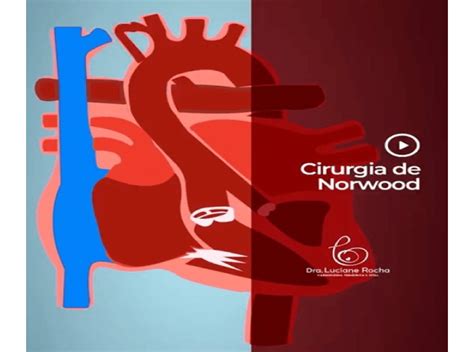 Cirurgia de Norwood - Norwood surgery - Perfusfind