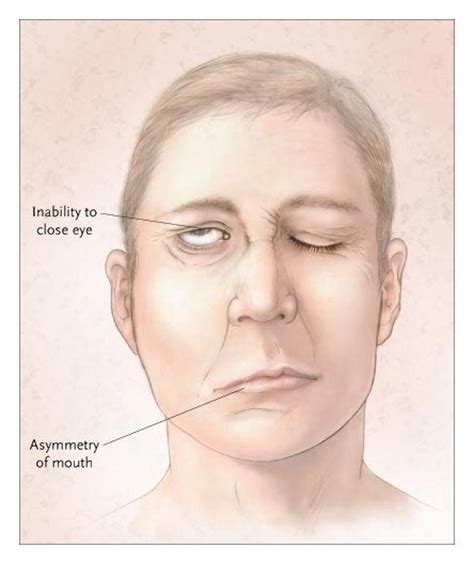 12 Common Myths About Strokes | Page 5 | Things Health