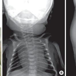 Clinical features of a campomelic dysplasia patient. (A) Pretibial skin ...