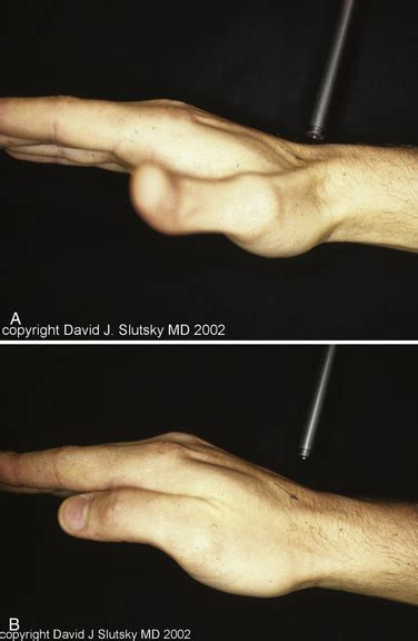 Midcarpal Instability | Clinical Gate