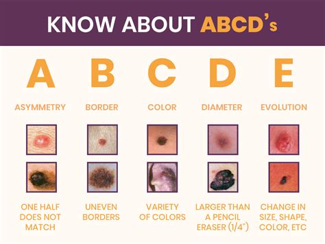 Main Types Of Skin Cancer