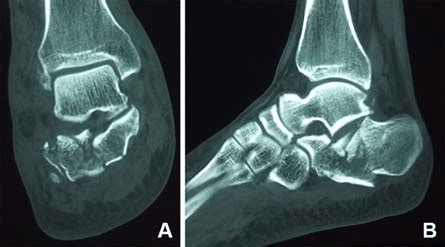 Computed tomography (CT) images of intraarticular calcaneal fracture... | Download Scientific ...