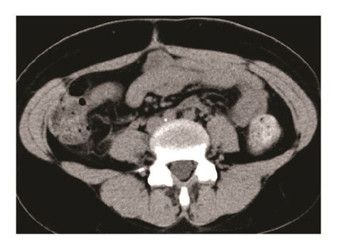 Abdominal plain CT scan one month after surgery. The retroperitoneal ...