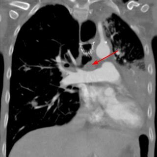 -CTA chest coronal view shows obstruction of the proximal left main... | Download Scientific Diagram