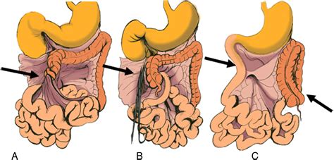 Assessment of recurrent abdominal symptoms after Ladd procedure ...