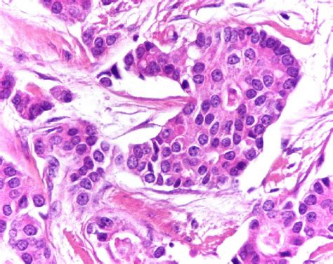 Infiltrating ductal carcinoma SBR 2 (HE, 40×) (Source Laboratory of ...