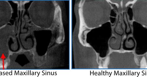 3-D Sinus Imaging - CT Scan of the Sinuses | NY Allergy & Sinus Centers