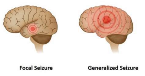 Generalized Onset Seizures - Epilepsy Foundation Texas