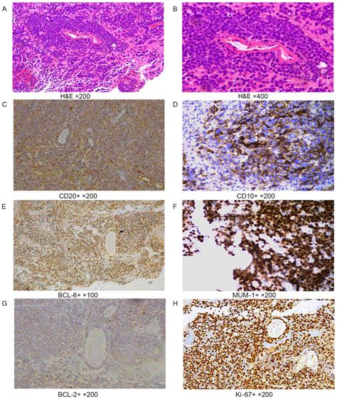 Immunohistochemical profile and prognostic significance in primary ...