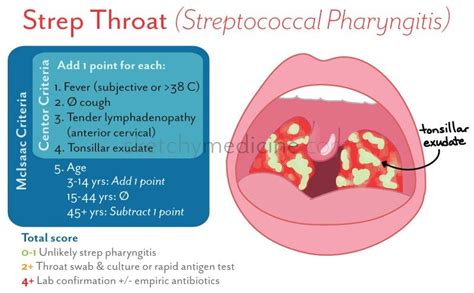 Sketchy Medicine | Streptococcal pharyngitis, Pharyngitis, Pediatric nurse practitioner