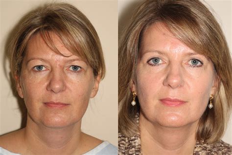 Upper Eyelid Surgery - before and after upper eyelid surgery Vancouver