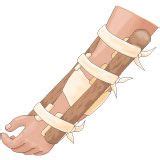 Make An Emergency Splint If You Break A Bone | Emergency, Emergency ...