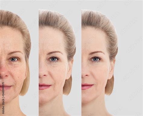 Foto Stock Face without makeup. Middle age close up woman face before after cosmetic. Skin care ...