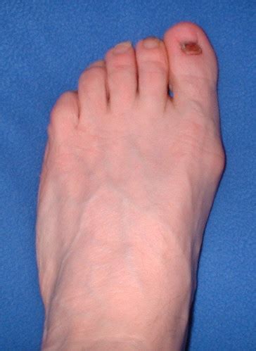 toe surgery - 1 month in | Flickr - Photo Sharing!