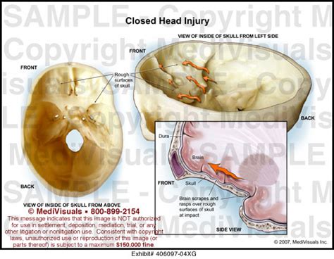 Closed Head Injury Medical Illustration Medivisuals