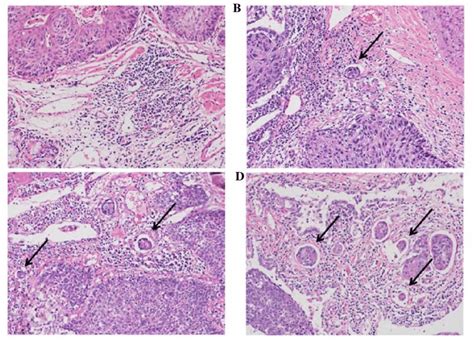 Squamous cell lung cancer patients with diabetes at higher risk of all-cause mortality