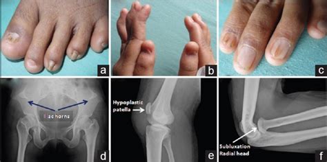 Nail-patella, syndrome