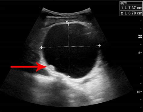 Clear Cell Papillary Renal Cell Carcinoma: A Rare Subtype