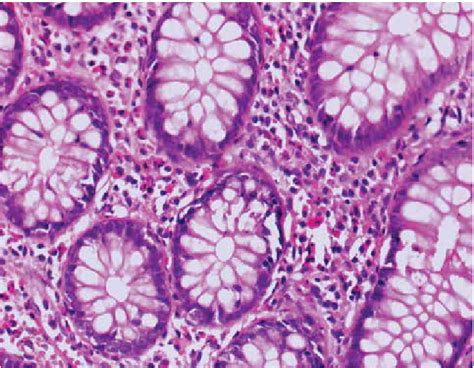 Colon biopsy (hematoxylin and eosin stain x100): Eosinophilic ...