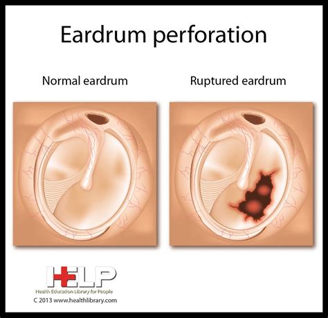 Eardrum Perforation | Oido