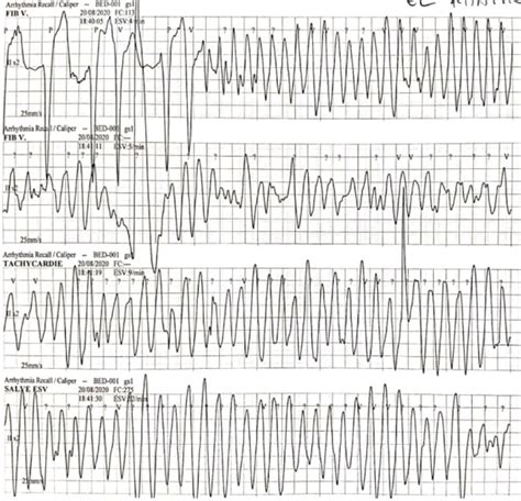 Monitoring trace showing the second episode of polymorphic VT after ...