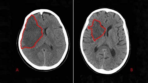 Stroke Ct Scan