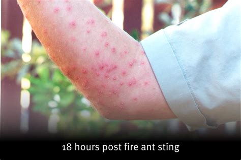 Stings | National Fire Ant Eradication Program