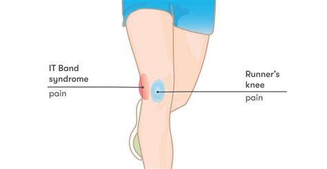 ITB (Iliotibial band) Friction Syndrome - Range Physiotherapy, iliotibial band syndrome ...