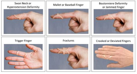 백조목 손가락 변형 (Swan Neck Deformity) 교정기_Oval-8® Finger Splints_백조목 ...