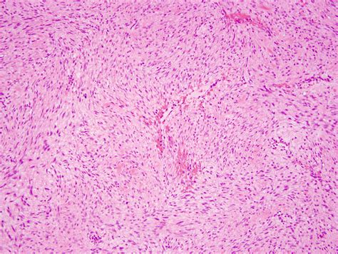 Pathology Outlines - Fibromatosis-desmoid