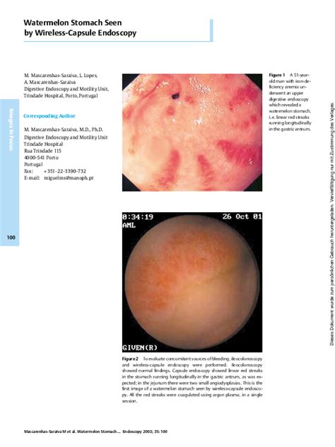 (PDF) Watermelon Stomach Seen by Wireless-Capsule Endoscopy | Luciana ...