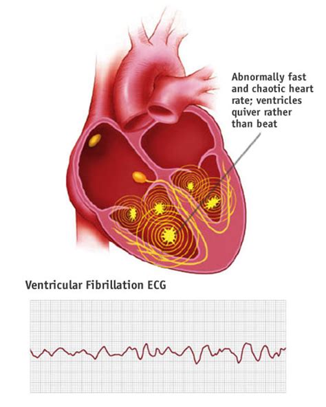 What is ventricular fibrillation (VF)? – CPR Test