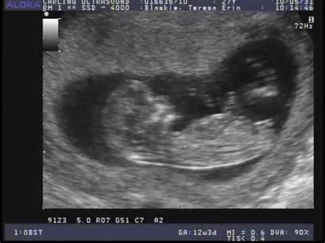 Our 12 Week Ultrasound Scan!! - YouTube
