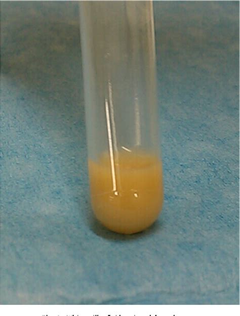 Figure 3 from Adult-onset Skene's gland cyst following a history of multiple gynecological ...