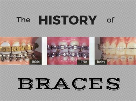 The history of braces - Dr Chauvin, Lafayette Dentist