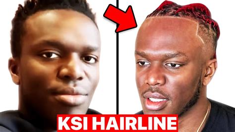 Hair Surgeon Reacts to KSI Hairline - YouTube