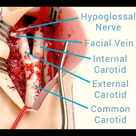 ReSuture - Carotid Endarterectomy Cartridge