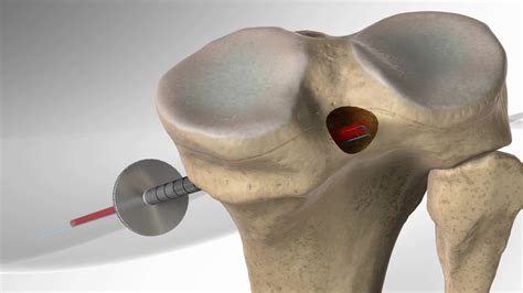 Arthrex - Inlay PCL Reconstruction with PCL TightRope® Technique