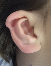 Cup Ear | Prominent Ears, Ear Pinning Surgery