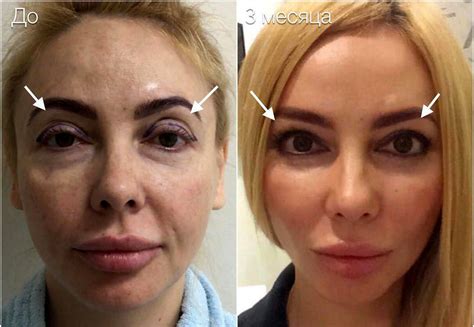 Facelift With Blepharoplasty » Eyelid Surgery: Cost, Photos, Rewiews, Q&A