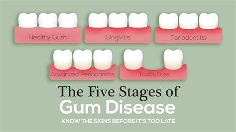 How do I know if periodontal disease worse? - Royal Dental Clinics Blog